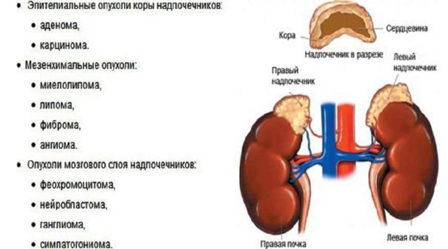 Аденома надпочечников у женщин: симптомы и лечение