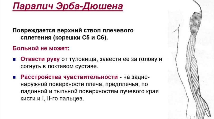 Акушерский паралич Дюшена – Эрба: причины, симптомы и методы лечения