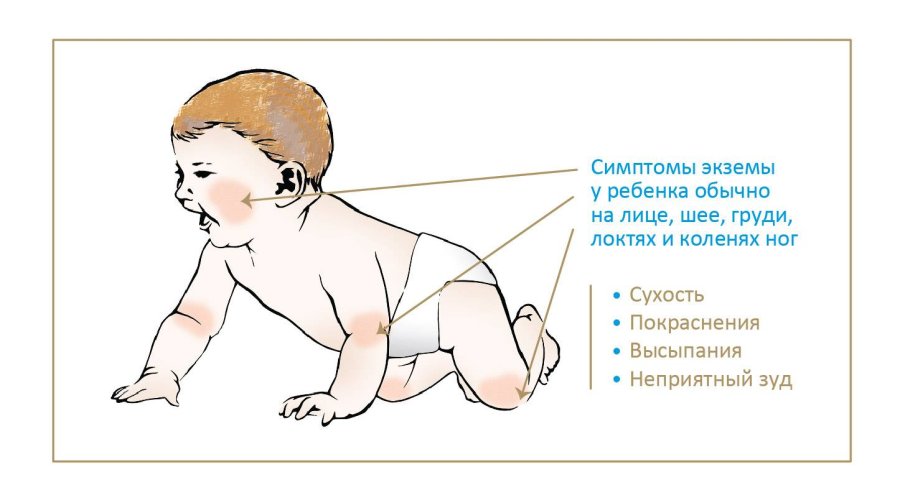 Аллергия на коровий белок у грудничка: причины, симптомы, лечение