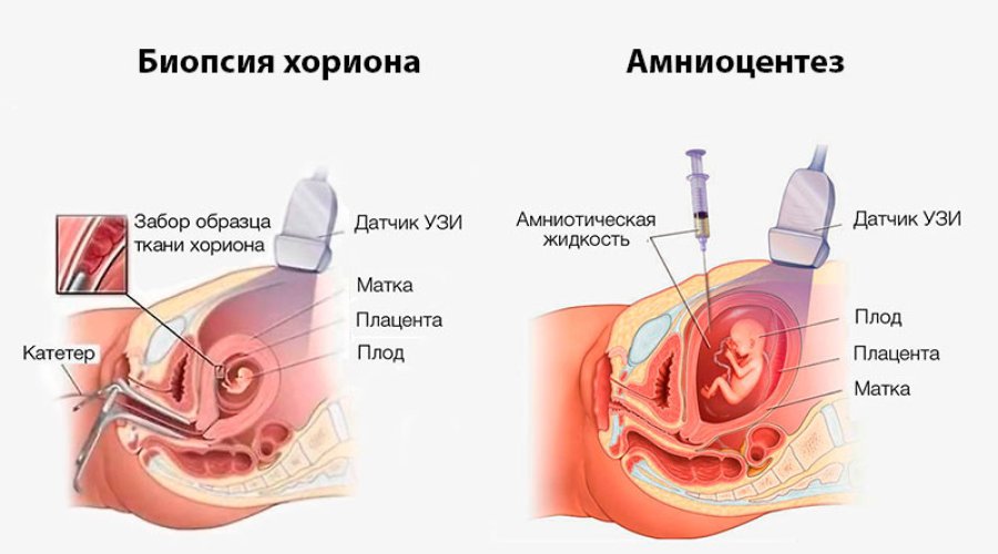 Биопсия хориона: метод и назначение