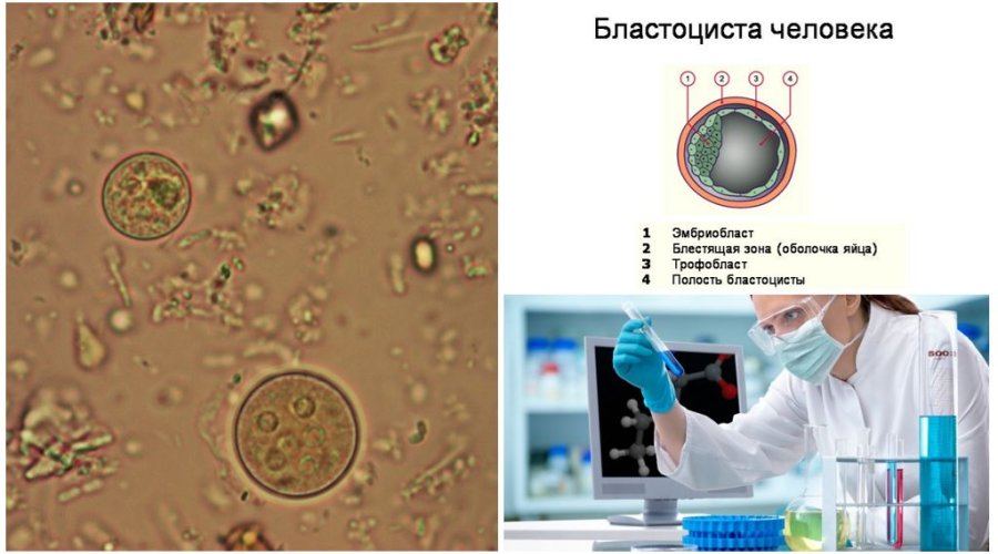 Бластоцисты в кале ребенка — причины, симптомы и лечение