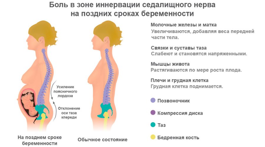 Боль в спине при беременности: причины и способы облегчения
