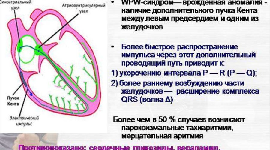 Чем опасен синдром Вольфа-Паркинсона-Уайта (синдром WPW)