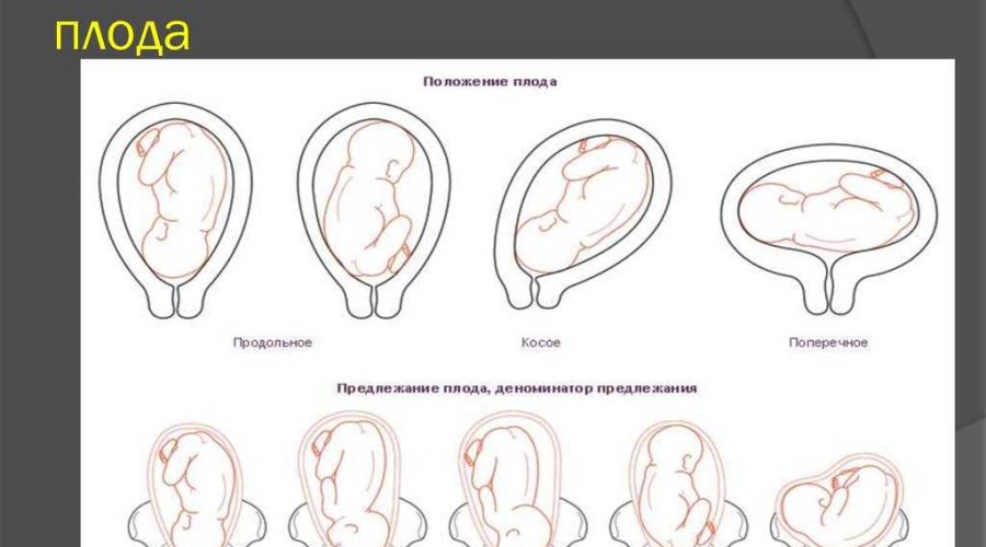 Чем отличается головное предлежание плода от продольного