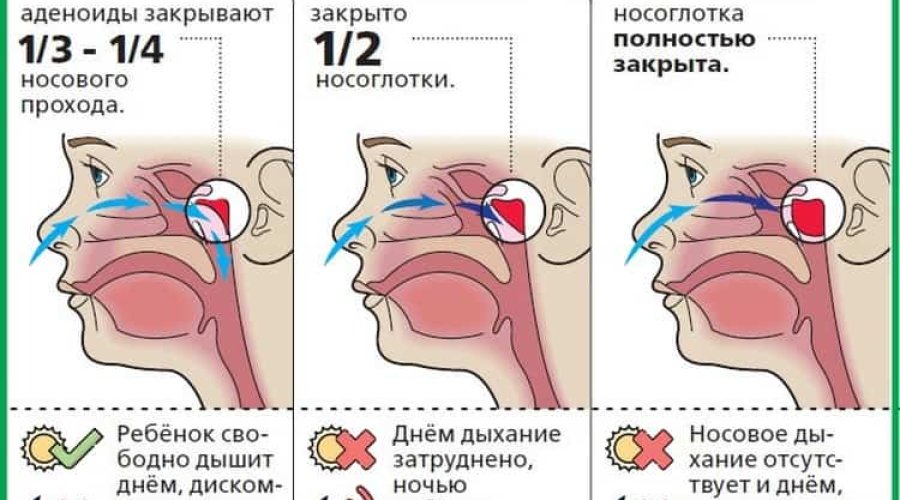Что делать, если не дышит нос: виды и лечение разных видов насморка