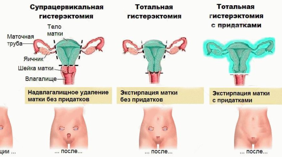 Что такое гистерэктомия матки — подробное объяснение и основные вопросы