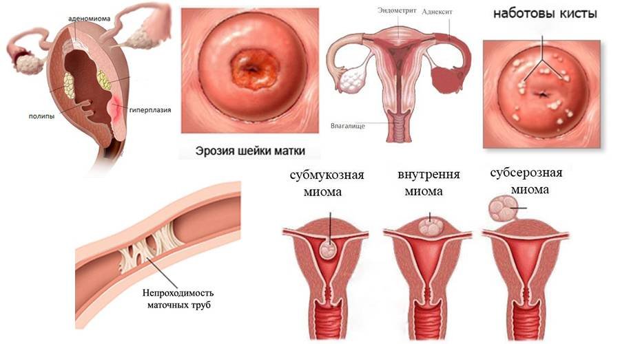 Что такое кисты эндоцервикса шейки матки: причины, симптомы и методы лечения