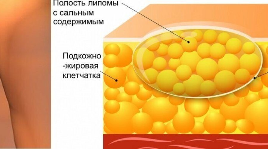 Что такое липома молочной железы и почему она появляется