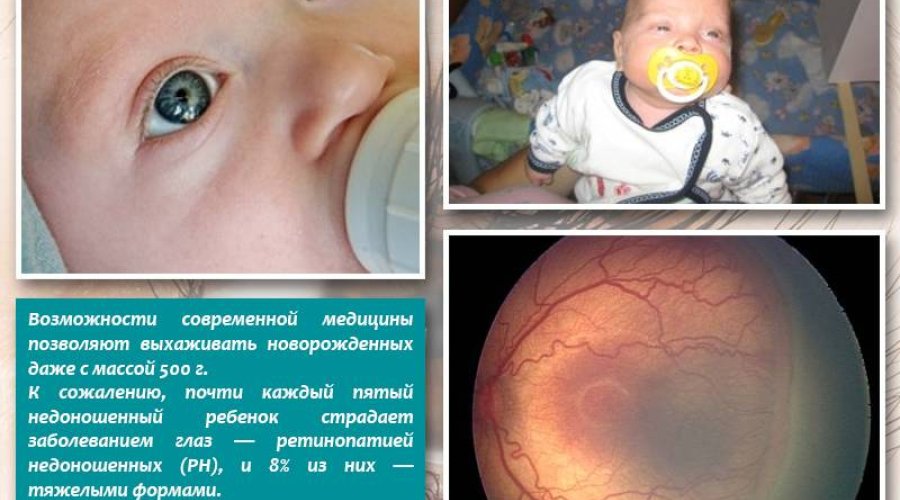 Что такое ретинопатия недоношенных: симптомы, причины, лечение