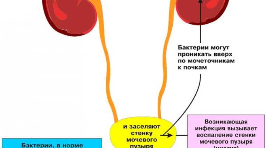 Цистит у женщин: особенности воспалительного процесса, факторы развития, течение и прогноз