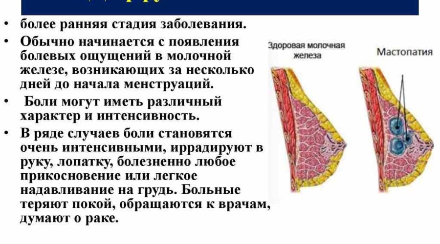 Диффузная мастопатия молочных желез: причины, симптомы, лечение