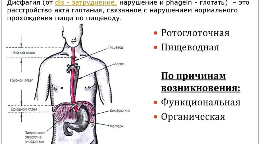 Дисфагия — признак многих болезней, который нарушает глотание