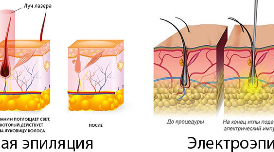 Электроэпиляция: принцип действия, подготовка и уход за кожей