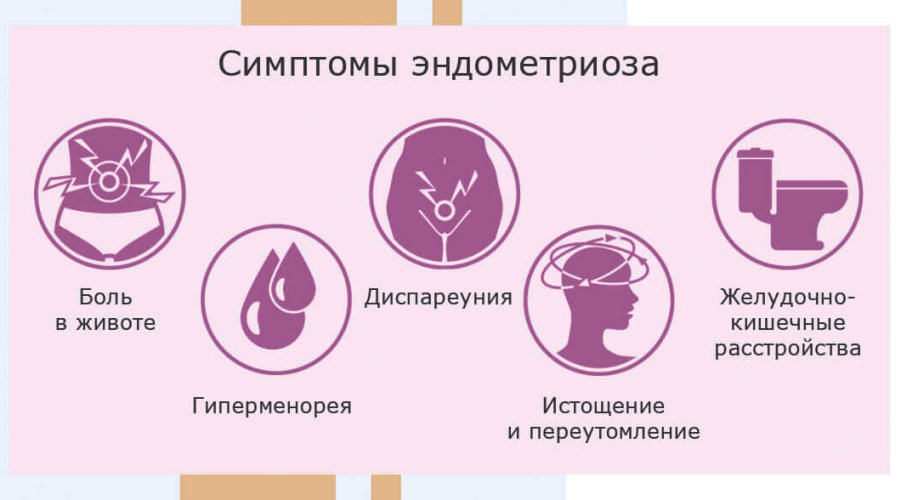 Эндометриоз матки: симптомы и эффективное лечение