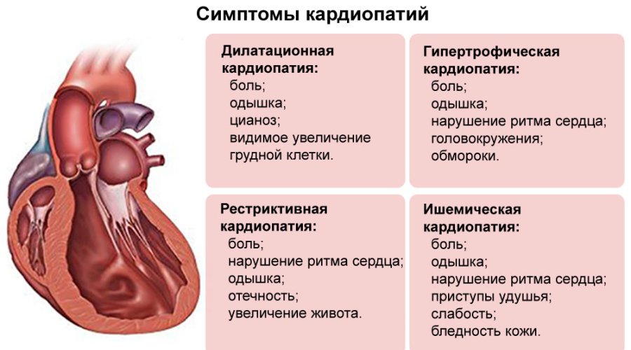 Функциональная кардиопатия у детей: причины, симптомы и лечение