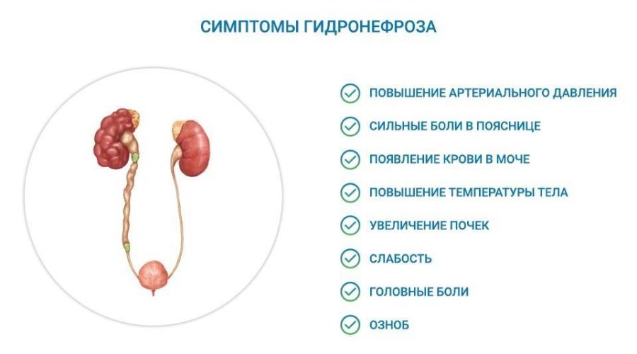 Гидронефроз почек у новорожденных: причины, симптомы, прогноз