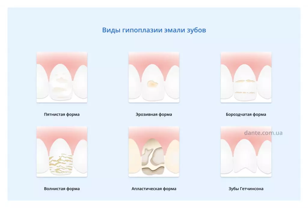 Гипоплазия эмали зубов у детей: причины, симптомы, лечение