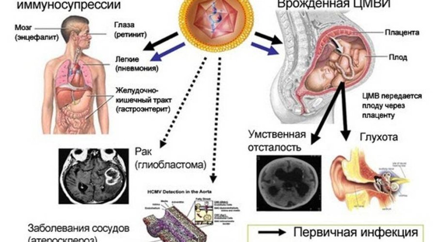 Инфекция цитомегаловирусом во время беременности: последствия и методы диагностики
