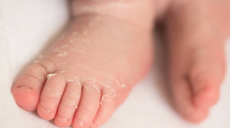 Как бороться с шелушением кожи у новорожденных на теле, руках и ногах
