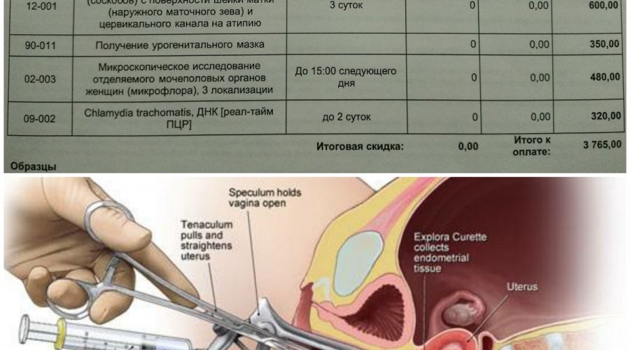 Как и зачем проводится анализ аспирата из полости матки