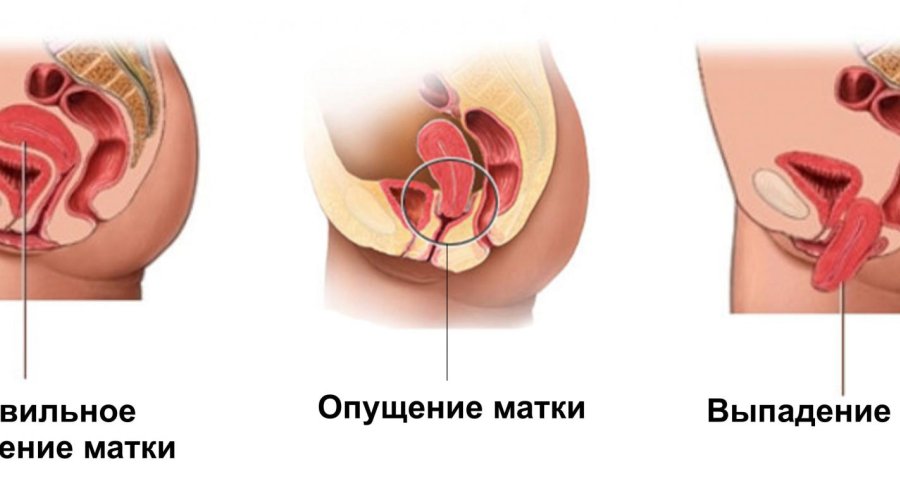 Как лечить выпадение матки у женщин