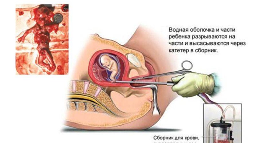 Как правильно провести процедуру выскабливания при замершей беременности