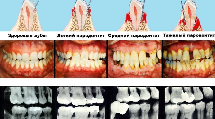 Как предотвратить гингивит у взрослых и детей для сохранения здоровья зубов и десен