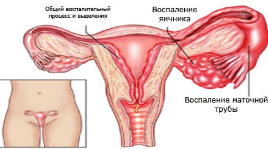 Как проявляется и чем опасно воспаление яичников | Женское здоровье