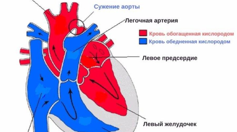 Коарктация аорты у детей: причины, симптомы и лечение порока сердца