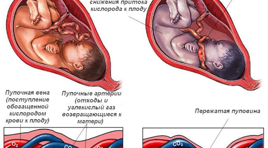 Короткая пуповина при родах: причины, осложнения, устранение | Все, что нужно знать
