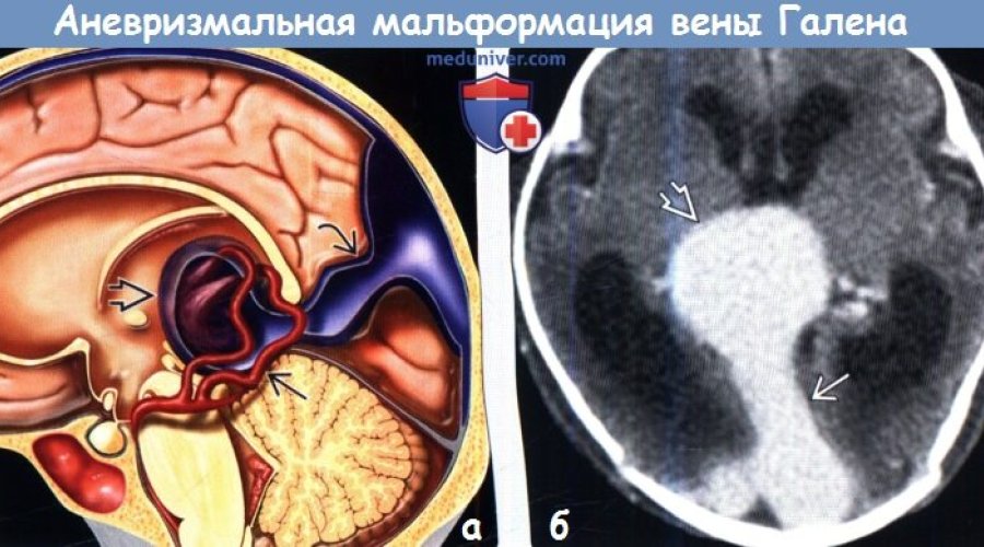 Мальформация вены Галена: эффективные методы лечения