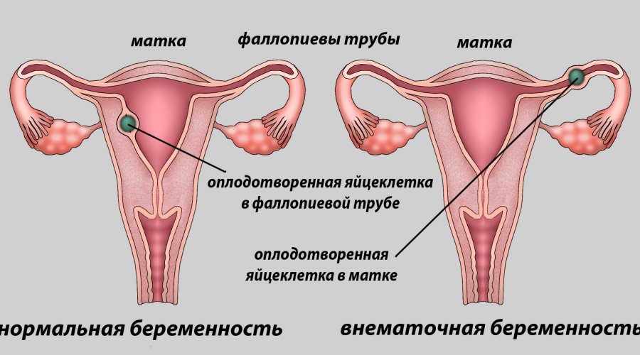 Месячные при внематочной беременности: причины и признаки