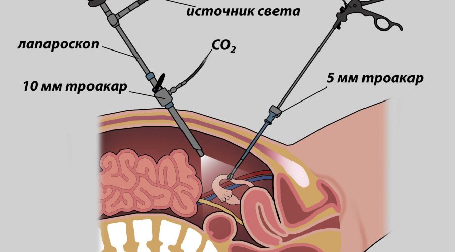 Методика лапароскопической операции на маточных трубах