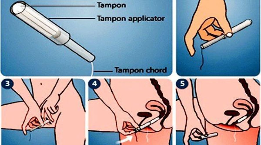 Можно ли использовать тампоны во время менструации? Ответ специалиста