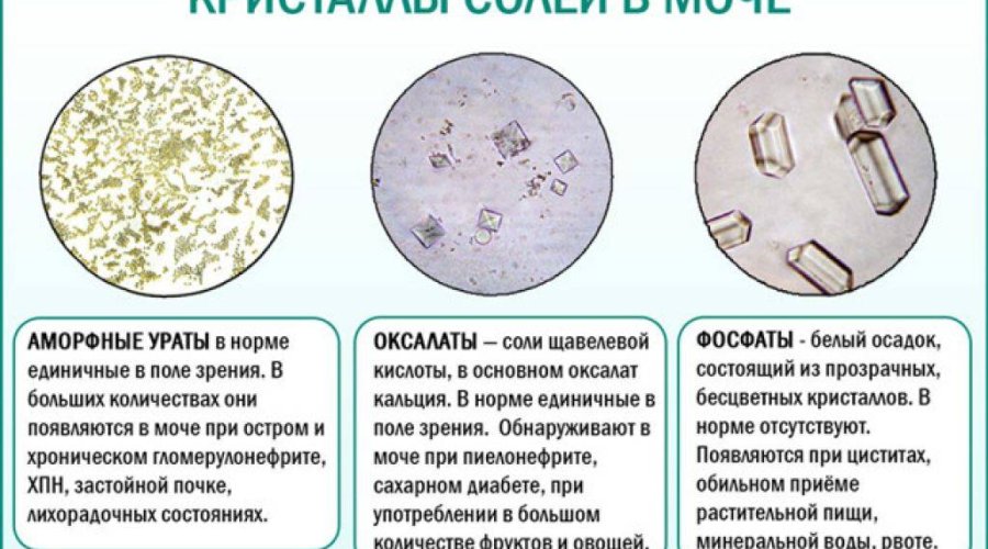 Оксалаты в моче у женщин: причины повышения и эффективное лечение