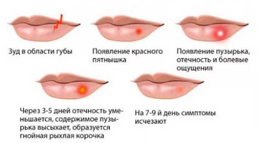 Опасен герпес на губах при беременности — причины, последствия и меры предосторожности