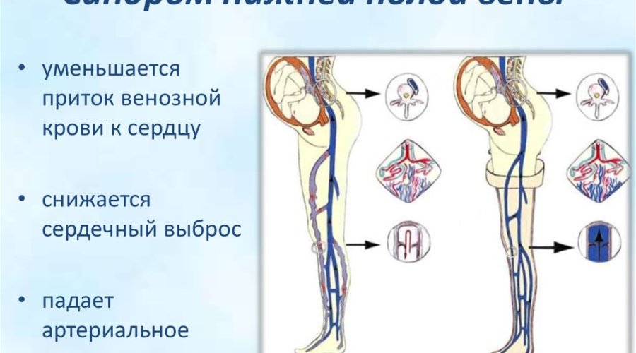 Опасность синдрома нижней полой вены для беременных