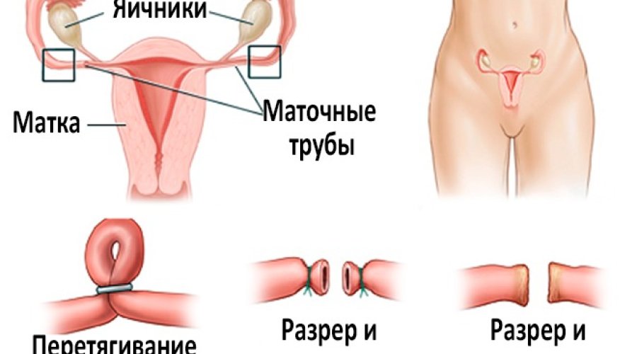 Перевязка маточных труб: принципы и последствия