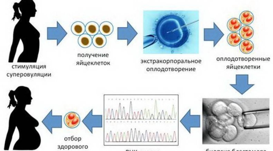 ПГД эмбриона при ЭКО — значимость и особенности процедуры