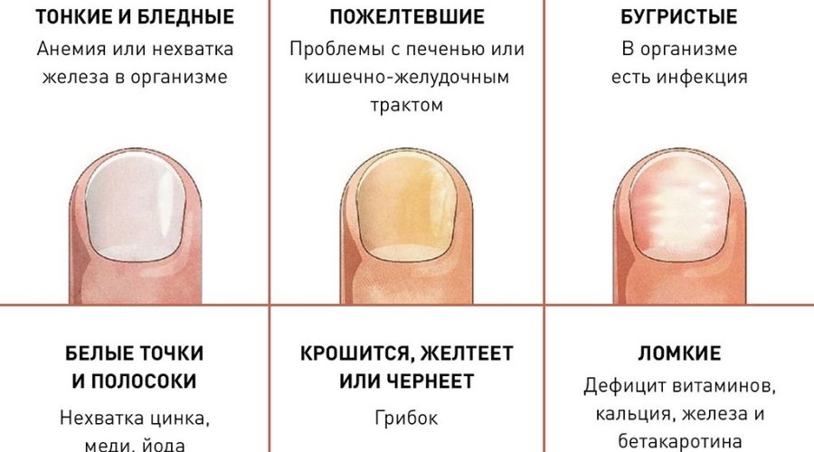 Плесень на ногтях после наращивания: причины и лечение, народные и медицинские средства