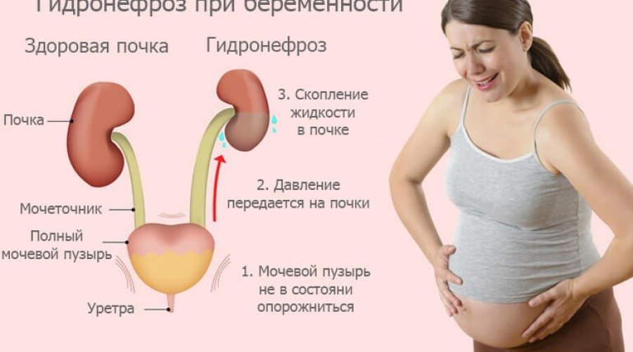Почему болят почки при беременности: причины и способы облегчения