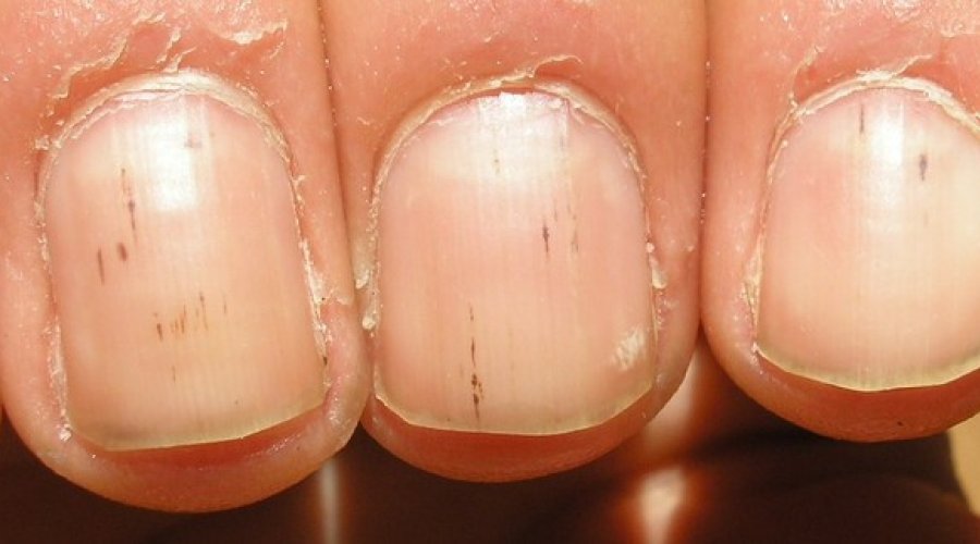 Почему появляются черные точки на ногтях и как избавиться от них?