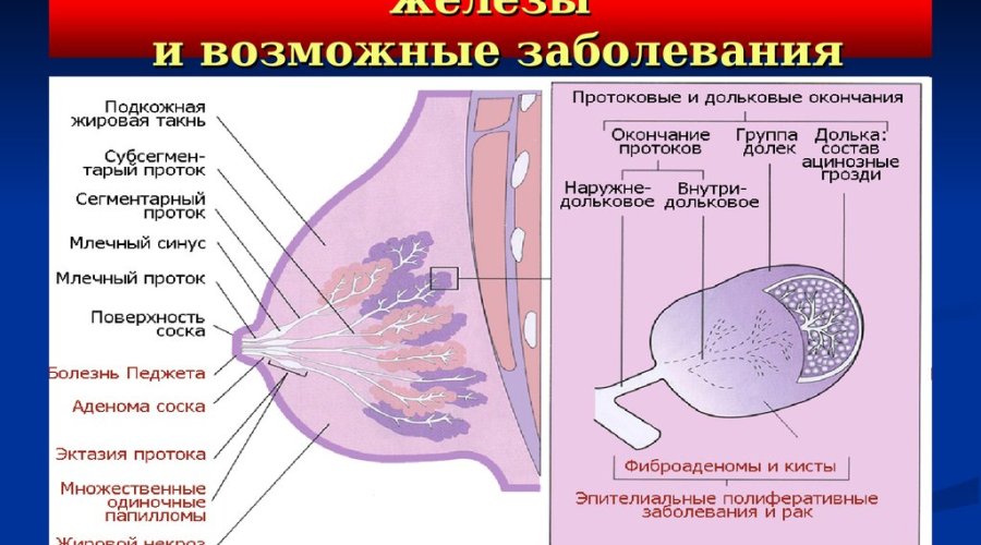 Почему возникает дуктэктазия молочной железы и как ее лечить