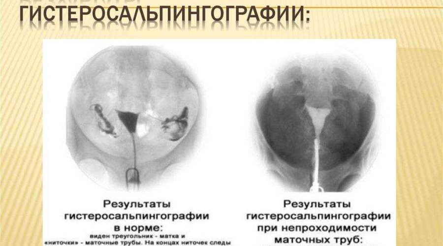 Подготовка к гистеросальпингографии маточных труб: полезные советы и рекомендации