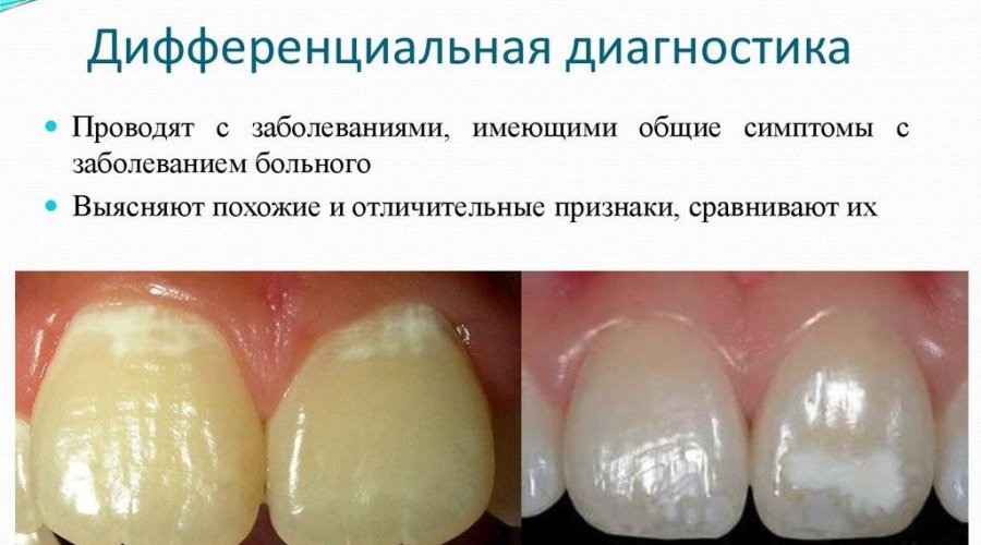 Причины и эффективное лечение белых пятен на зубах