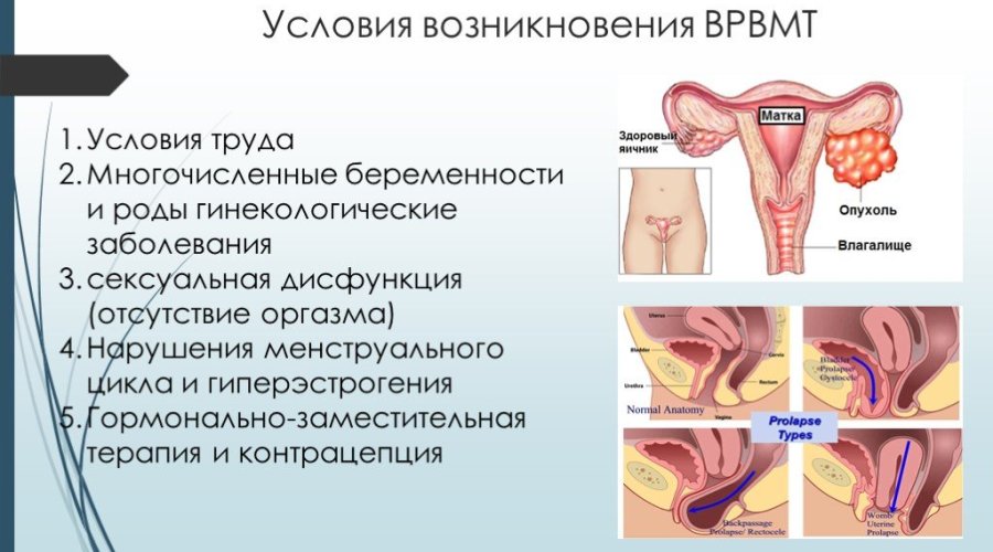 Причины и эффективное лечение варикоза матки