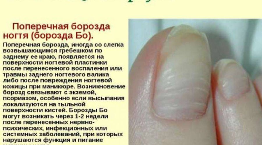 Причины и эффективное лечение волнистых ногтей на руках