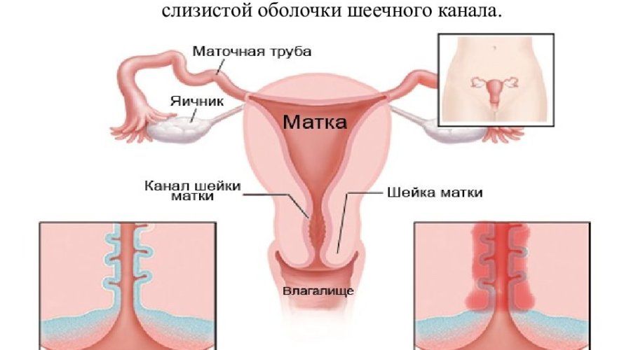 Причины и лечение эндоцервицита у женщин: полезная информация