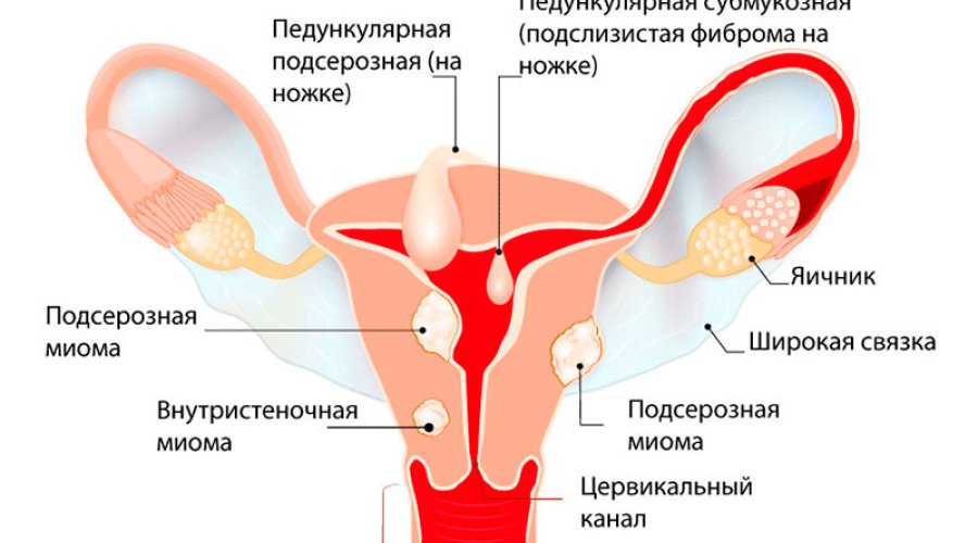 Причины и лечение фиброматоза матки: симптомы, диагностика и эффективные методы