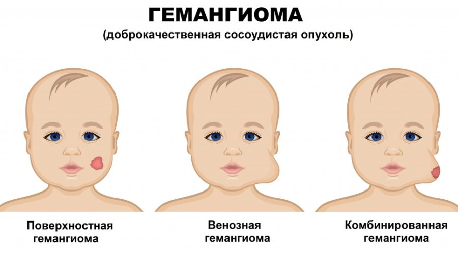 Причины и лечение гемангиомы у новорожденных: полное руководство